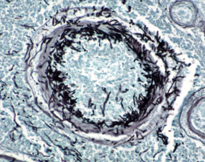 <p>what type of pathogen caused this lesion?</p>