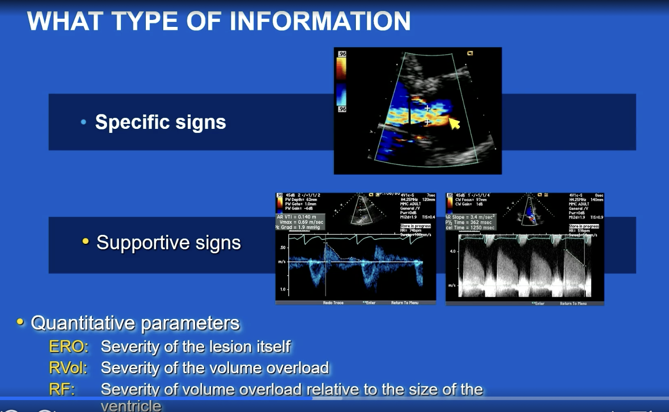 <ol><li><p>Vena Contracta</p></li><li><p>Supportive signs include — flow diastolic reversal in the aorta and PHT</p></li></ol><p></p><p>Quantitative parameters</p><ol start="3"><li><p>ERO</p></li><li><p>RVol</p></li><li><p>RF (compares severity of the vol overload relative to size of the ventricle)</p></li></ol><p></p>