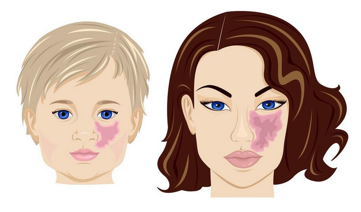 <p>donker-rode tot paars-rode vlek </p>