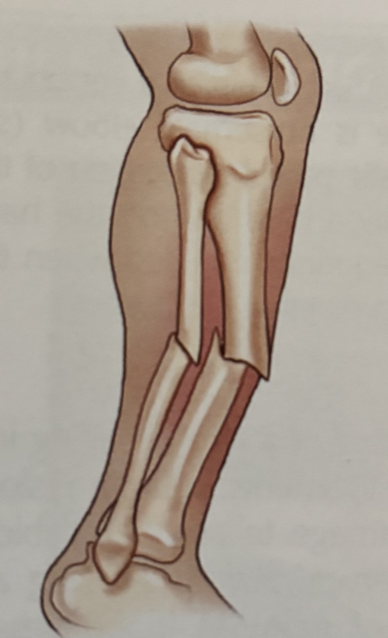 <p>What type of fracture is this?</p>