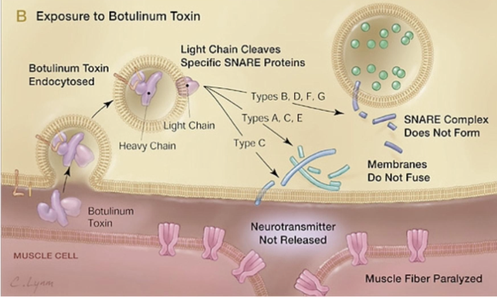 <ul><li><p>botulinum toxin = widely known for causing a type of food poisoning known as botulism</p></li><li><p>botulinum toxin (BTX or BonT) = protein produced by spore-forming, anaerobic, bacilli bacterium <em>clsotridium botulinum</em></p></li><li><p>botulinum toxins work by <strong>inhibiting the release</strong> of the ubiquitous neurotransmitter <strong>ACH</strong> → paralyzing muscle</p></li><li><p>botox = cosmetic uses; mainly used to relax the muscles that cause wrinkles</p></li></ul><p></p><p>pathway</p><ul><li><p>botulinum toxin endocytosed into presynaptic nerve terminal at NMJ → light portino of toxin is released into the cytosol → cleaves specific SNARE proteins</p><ul><li><p>type B, D, F, G → cleave synaptobrevin</p></li><li><p>type A, C, E → cleave SNAP-25</p></li><li><p>type C → cleaves syntaxin</p></li></ul></li><li><p>→ cleavage of SNARE proteins prevents the formation of SNARE complex which is essential for fusion of synaptic vesicles w/pre-synaptic membrane → ACH NOT released into synaptic cleft</p></li></ul><p></p>