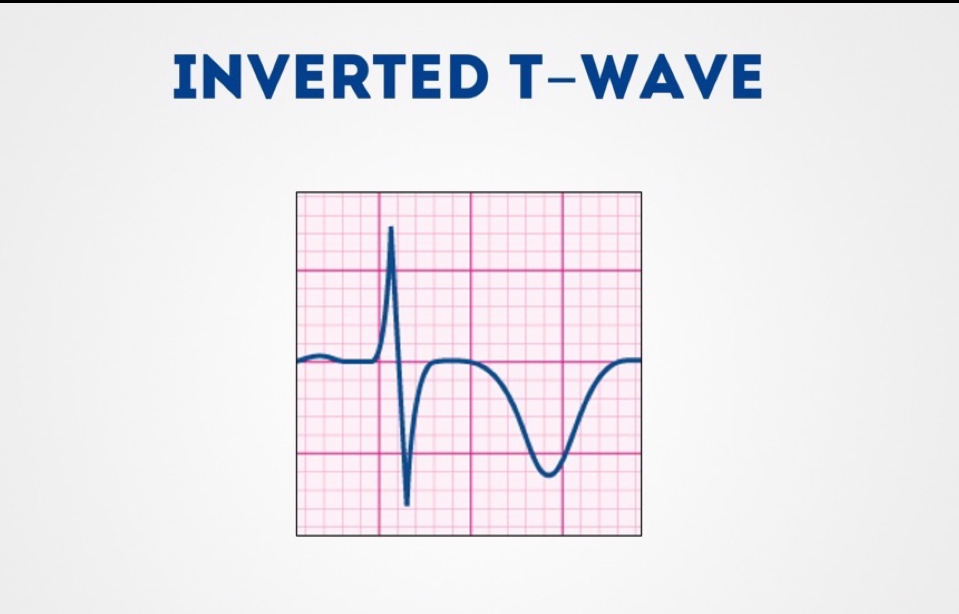 <p>Chest pain + T wave inversion. what ecg condition does it mean?</p><p></p><p>What drugs should be given immediately</p>
