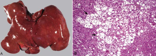 <p>What change does this liver show? Give cause</p>