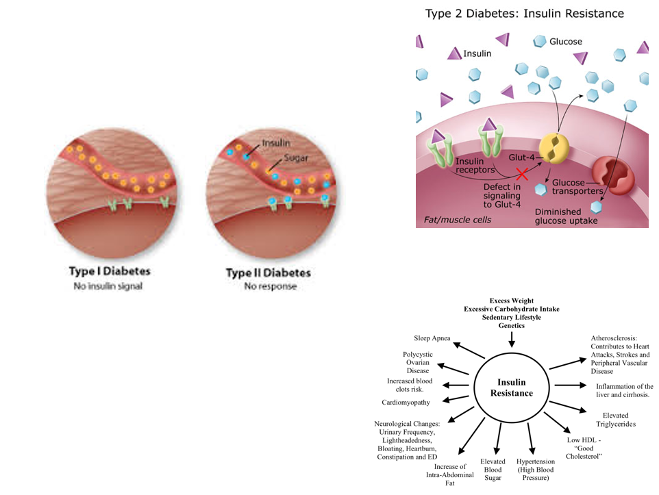<ul><li><p><strong>Type 1 - 10% of cases - “juvenile”</strong></p><ul><li><p>Autoimmune disorder - antibodies produced that destroys β cells</p></li><li><p>Insulin dependent - injections are required</p></li><li><p>Symptoms:</p><ul><li><p>increased thirst and hunger, frequent urination, yeast infections, headache, unexplained weight loss, fatigue and weakness</p></li></ul></li></ul></li><li><p><strong>Type 2 - 90% of cases - “Adult”</strong></p><ul><li><p>Reduced ability of tissues to respond to insulin</p></li><li><p>Non-insulin dependent</p></li><li><p>Non-pharmaceutical treatments include diet, exercise, &amp; weight loss</p></li><li><p>Symptoms: excessive thirst and hunger, frequent urination, unexplained weight loss, fatigue, genital yeast, headaches</p></li></ul></li></ul><p></p>