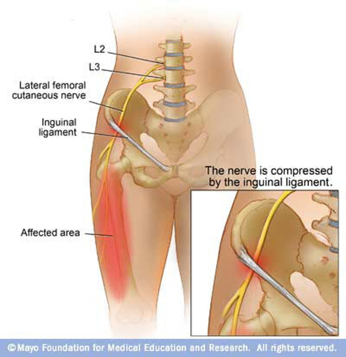 <p>Dysesthesia &amp; sensory loss of the lateral thigh</p>