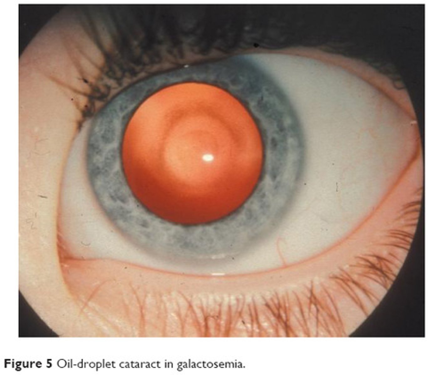 <p>Central oil droplet cataract since the body cannot metabolize galactose</p>