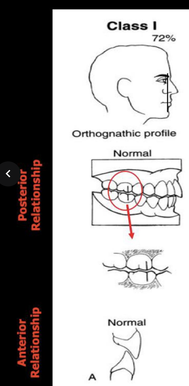 <p>Orthognathic profile (72% angle), posterior- mesiobuccal cusp of 1st max molar aligns with buccal groove of mand 1st molar, anterior-lower incisors rest on the cingulum of the upper incisors</p>