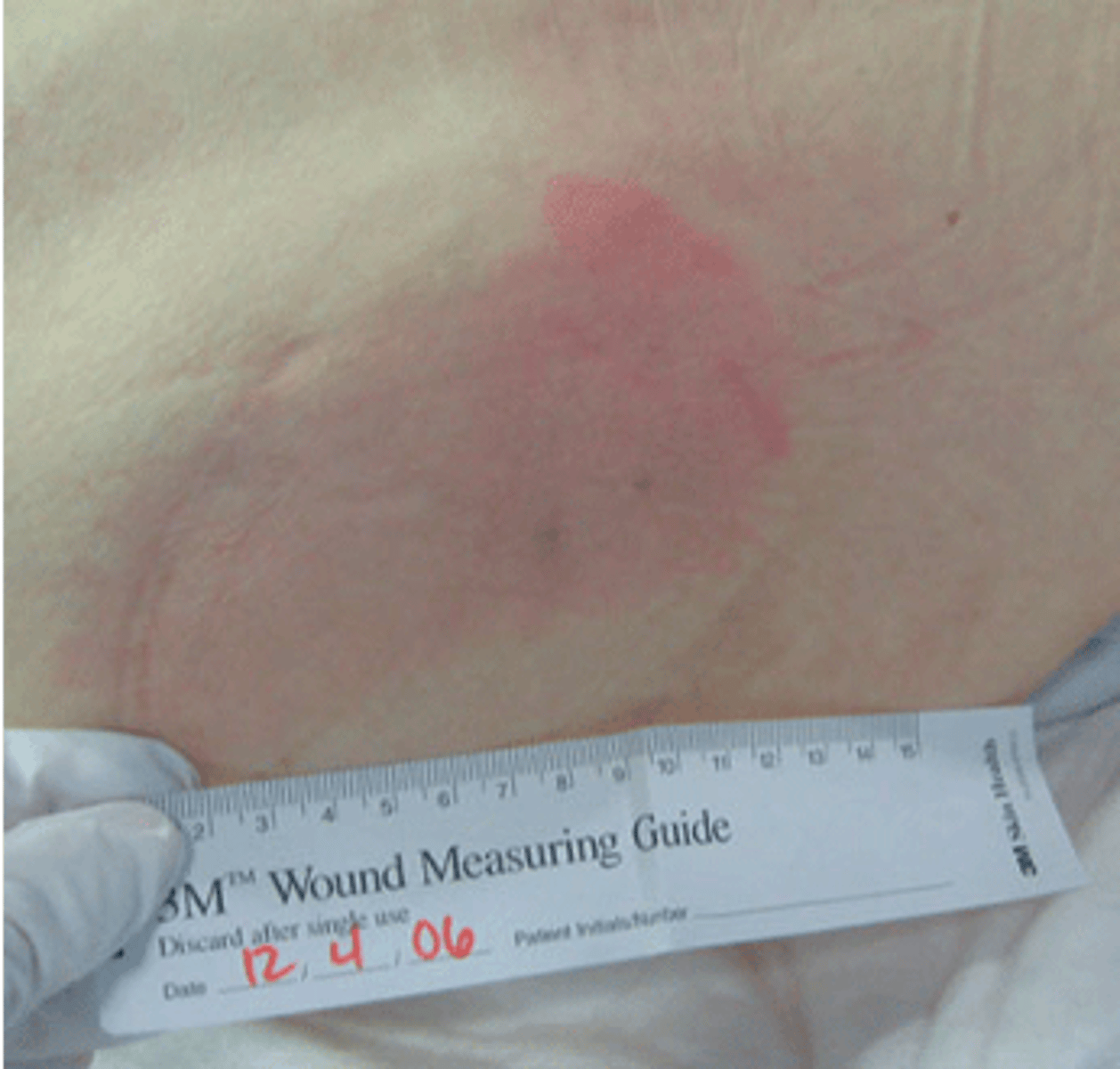 <p>Limited to epidermis</p><p>Red, non-blanching erythema</p><p>Does not resolve in 20 minutes</p><p>No breakdown in skin</p><p>More difficult to see in darker skin (high risk)</p><p>Increased risk with comorbidities</p>