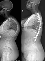 <p><strong>thoracic </strong>vertebrae curvature “hump back” </p>