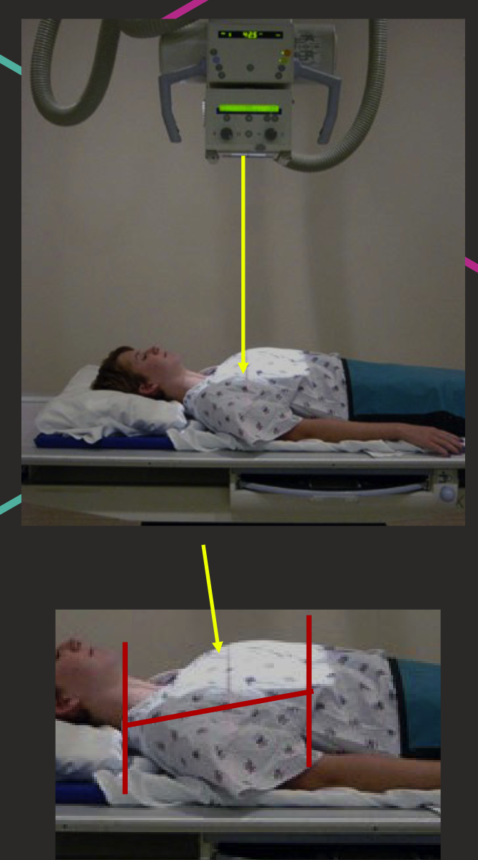 <ul><li><p>Lying on their back on bed.</p></li><li><p>Chin raised, arms by sides.</p></li><li><p>IR behind patient’s back or in table bucky.</p></li><li><p>Top border C7.</p></li><li><p>10-15<span>° caudal angulation (to sternum).</span></p></li><li><p><span>Central Ray approx. T7.</span></p></li></ul><p></p>