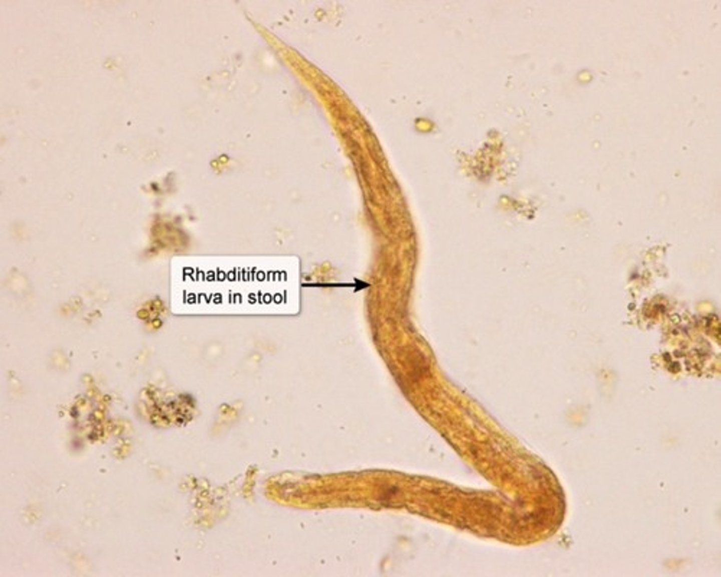 <p>Threadworm</p><p>Transmission</p><p>-Larvae in Soil penetrate skin</p><p>Sx</p><p>-Duodenitis</p><p>-Dry cough</p><p>-Hemoptysis</p><p>-Skin pruritus</p><p>Dx</p><p>-Rhabditiform larvae on stool</p><p>Tx</p><p>-Albendazole</p><p>-Ivermectin</p>