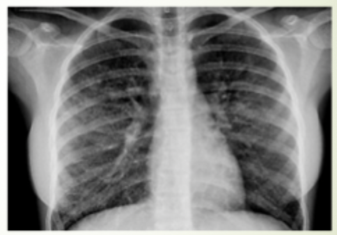 <p>An 18 y/o male presents to the ER for SOB and chest pain. Patient also reports N/V/D, cough, and chills. In your history you discover that your patient loves a mango juul. Vitals are stable with the exception of a fever 101.4, 123 bpm, and 89% O2sat on RA. CXR shows bilateral ground glass. How are you managing this patient?</p>