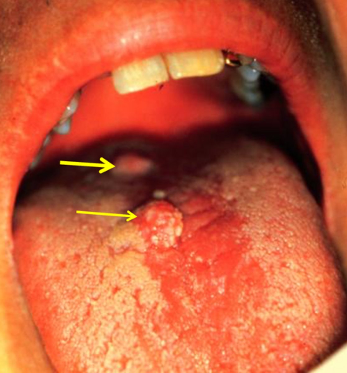 <p>condyloma acuminatum</p>