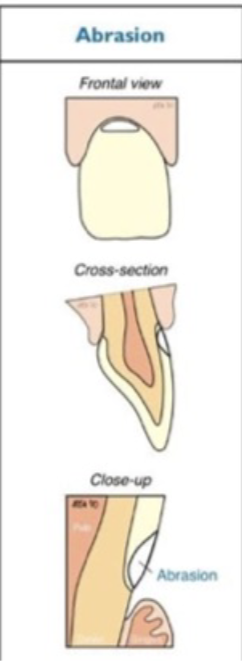 <p>mechanical wear- like toothbrush habit </p>