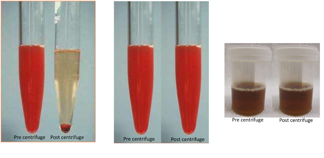 <p>Label the image from left to right; options = myoglobinuria, hematuria, and hemoglobinuria </p>