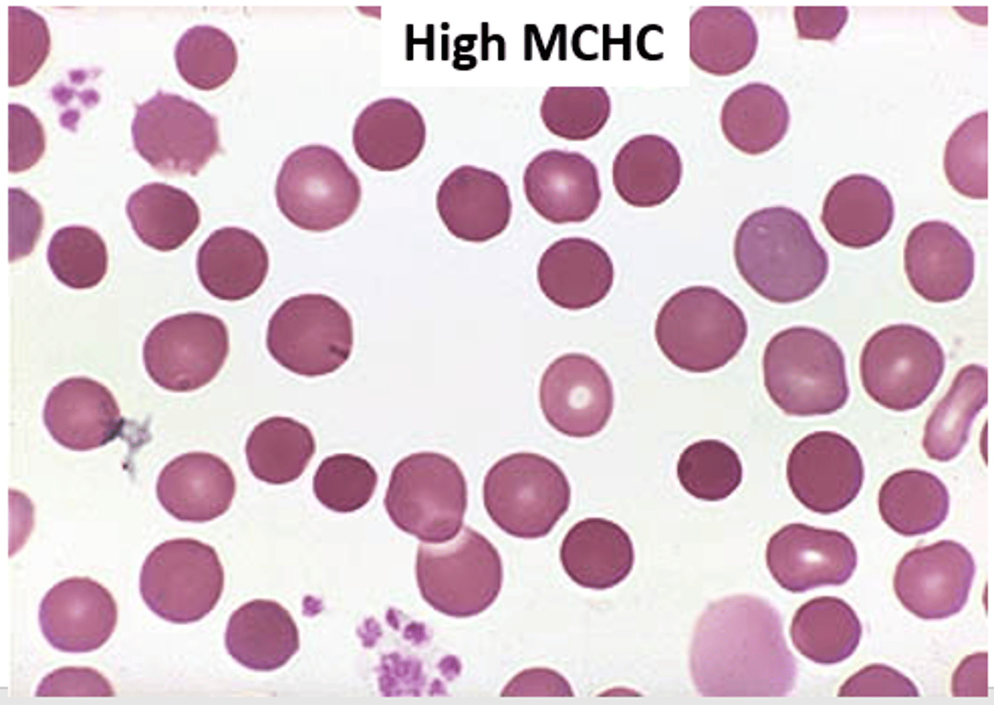 <p>(cell color)</p><p>increased pigment (lack of central pallor)</p>
