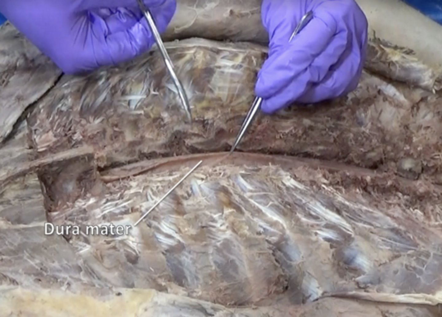 <p>thick, outermost layer of the meninges surrounding and protecting the brain and spinal cord</p>