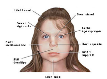 <p><strong>Troligaste diagnos:</strong><br><span data-name="check_mark_button" data-type="emoji">✅</span> <strong>Fetalt alkoholsyndrom (FAS).</strong></p><ol><li><p class="ds-markdown-paragraph"><strong>Symmetrisk tillväxthämning</strong> (vikt, längd, huvudomfång) är en central del av FAS.</p></li><li><p class="ds-markdown-paragraph"><strong>Ansiktsdysmorfier</strong>:</p><ul><li><p class="ds-markdown-paragraph">Korta ögonspringor (korta palpebrala springor).</p></li><li><p class="ds-markdown-paragraph">Utplattad philtrum (långt avstånd näsa–överläpp).</p></li><li><p class="ds-markdown-paragraph">Tunn överläpp.</p></li><li><p class="ds-markdown-paragraph">Bred näsrot.</p></li></ul></li></ol><p></p>