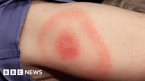 <p>Borrelia Burgdorferi</p><p>fever, headache, myalgia</p><p>BULLS EYE-RASH- erythema migrans, starts as a small red PAPULE and expans outwards with a clear zone forming around papule.</p><p>MOST COMMON VECTOR-BORNE DISEASE IN US.</p><p>(Deers- Rodents)</p><p>Bite of infected DEER or BLACKLEGGED TICK </p>