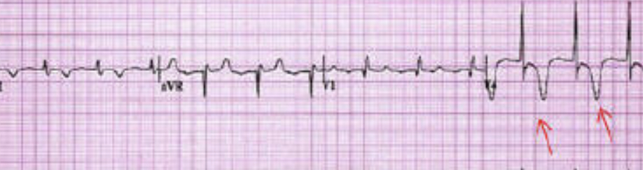 <p>NSTEMI - What is it? Causes?Signs and symptoms&gt;?</p>