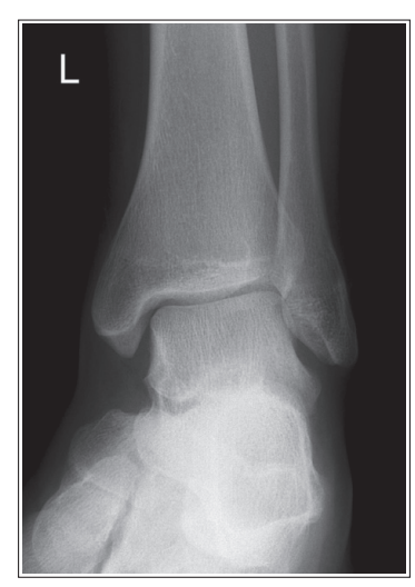 <p>What are issues with this mortise ankle? </p>