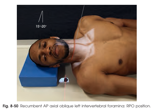 <ul><li><p>Patient rotated 45° (body and head).</p></li><li><p>Center spine to grid; support lower thorax/hip and head so cervical column is horizontal.</p></li><li><p>Chin elevated and jaw protruded as in upright.</p></li></ul><p></p><p>AP axial oblique projection of the cervical intervertebral foramina</p>