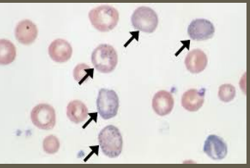 <p><strong>Lead Poisoning: Labs</strong></p><p>-CBC → _________ stippling common</p><p>-Iron studies → associated with ____ deficiency anemia </p><p>-Blood lead levels </p><ul><li><p>>_ mcg/dL leads to diagnosis</p></li><li><p>>10 mcg/dL leads to more ______ symptoms </p></li><li><p>>____ mcg/dL leads to encephalopathy </p></li></ul><p></p>