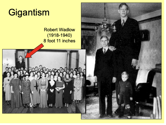 <p>Gigantism→ over secretion from a <strong>pituitray tumour</strong></p><ul><li><p>Extreme height is due to overstimulation at the growth plates of the long bones</p></li></ul><p></p>