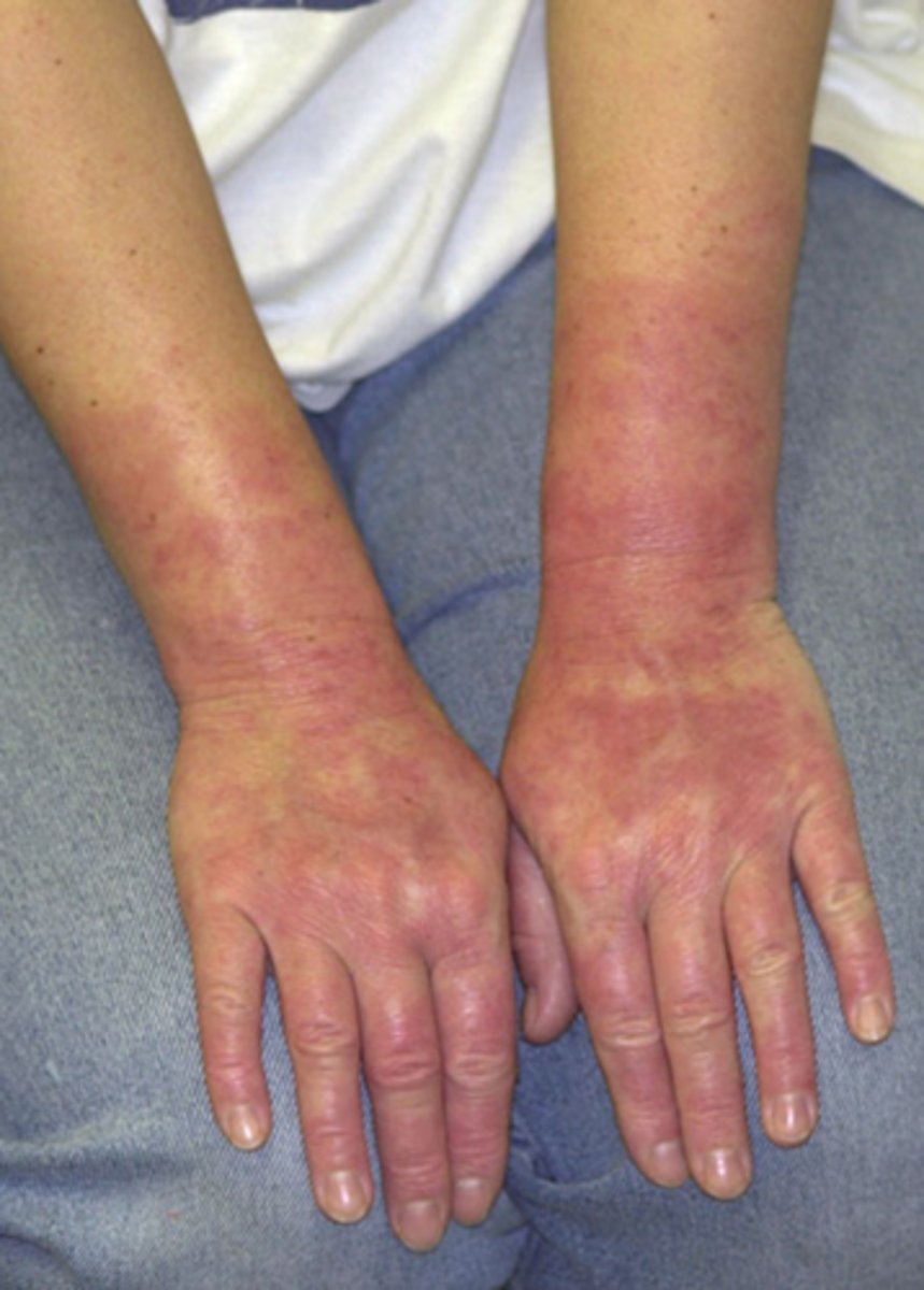 <p>healthcare worked are most at risk! use latex free gloves!</p>