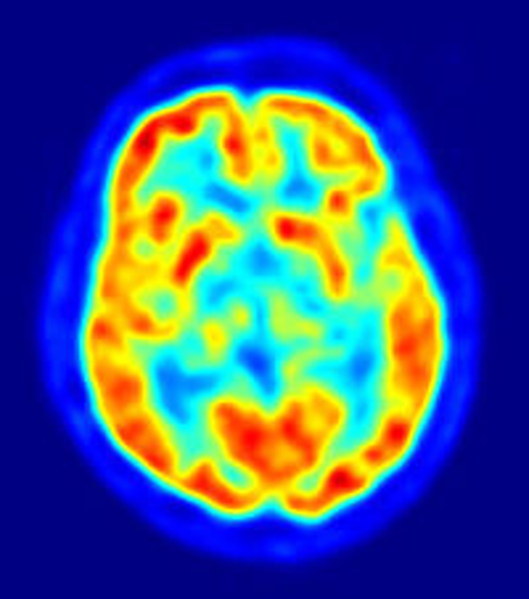 <p>a visual display of brain activity that detects where a radioactive form of glucose goes while the brain performs a given task such as movement or talking</p>