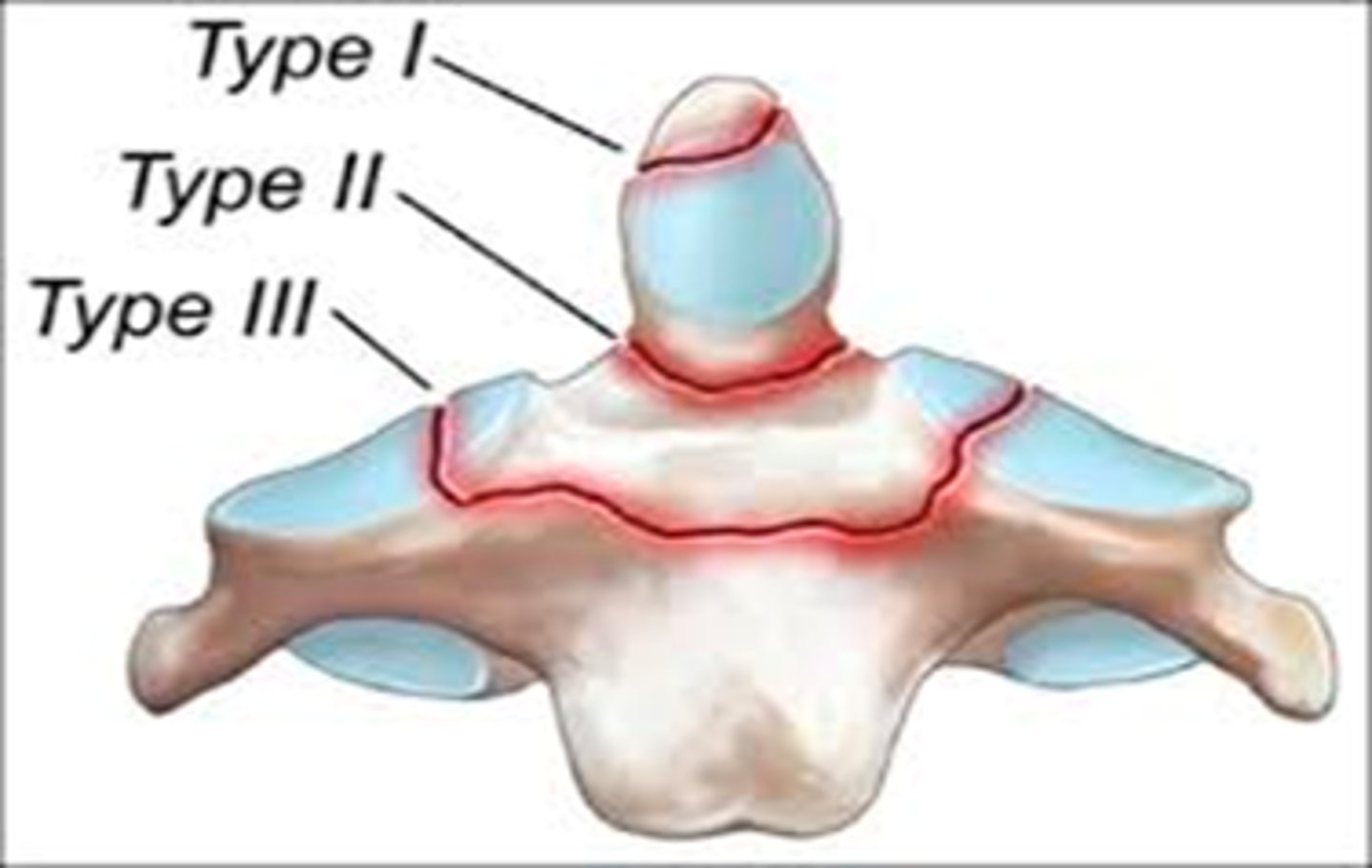 <p>type 1 = rare, avulsion injury of alar ligament w oblique fx at tip of dens</p><p>type 2 = MC, base of dens</p><p>type 3 = fx of dens to body of C2</p>