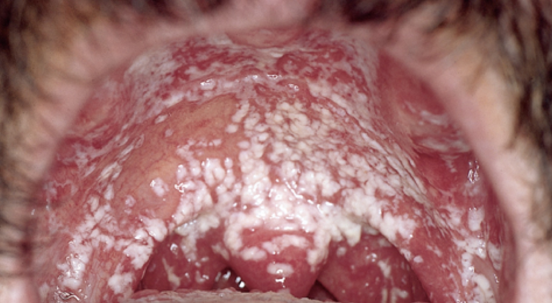 What organism is responsible for the infection seen in the image? 

A. Candida 

B. Staph 

C. Tinea 

D. Herpes simplex