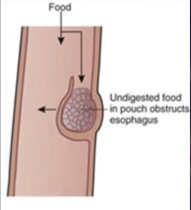<ul><li><p>Etiology </p><ul><li><p>Acquired condition</p></li><li><p>Most common cause: impaired esophageal motility</p></li><li><p>May be caused by traction on esophagus due to inflammatory disease of mediastinum (e.g., tuberculosis)</p></li></ul></li><li><p>Pathogenesis</p><ul><li><p>Pressure increases- esophageal lumen</p></li><li><p>Esophageal mucosa protrudes through weakened esophageal wall and produces outpouching </p></li></ul></li></ul><p></p>