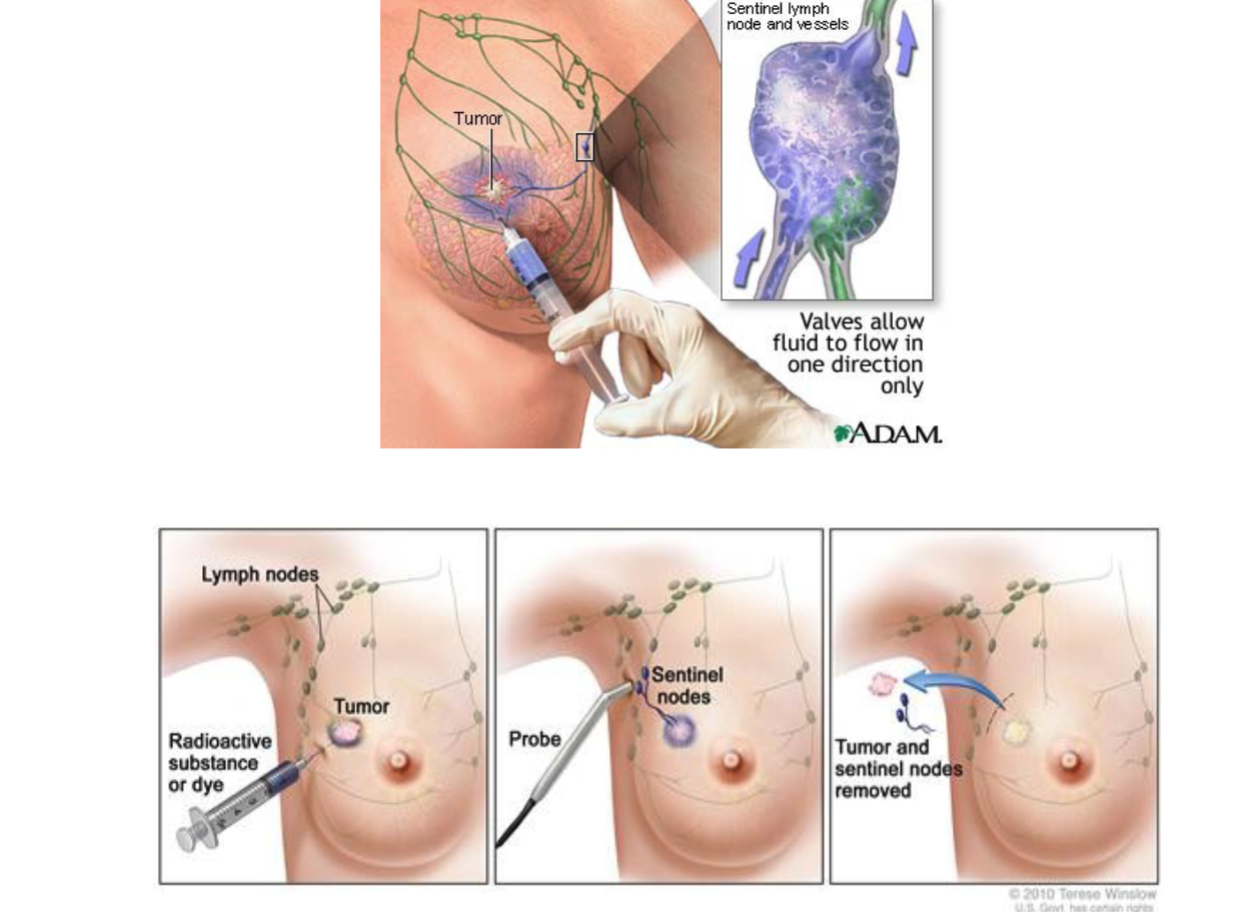 <p>to check if cancer has spread to the first draining lymph node, which helps avoid removing unnecessary nodes.</p>