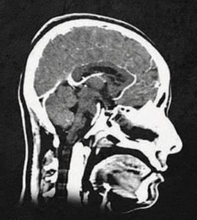 <ul><li><p>a series of X-ray photographs taken from different angles and combined by computer into a composite representation of a slice of the brain’s structure</p></li></ul><p></p>