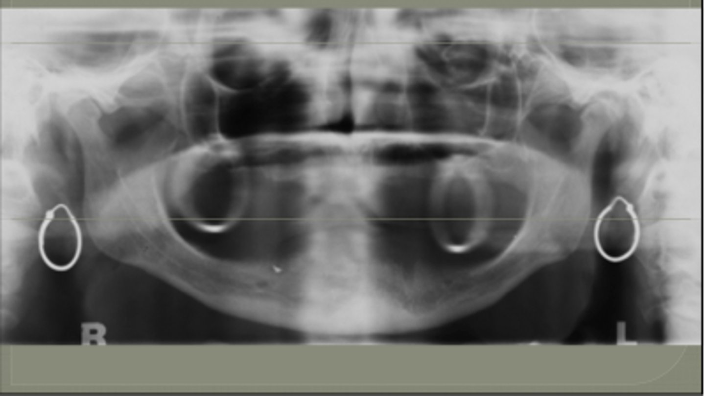<p>Higher level<br>Contralateral<br>Blurred/ significantly magnified</p>