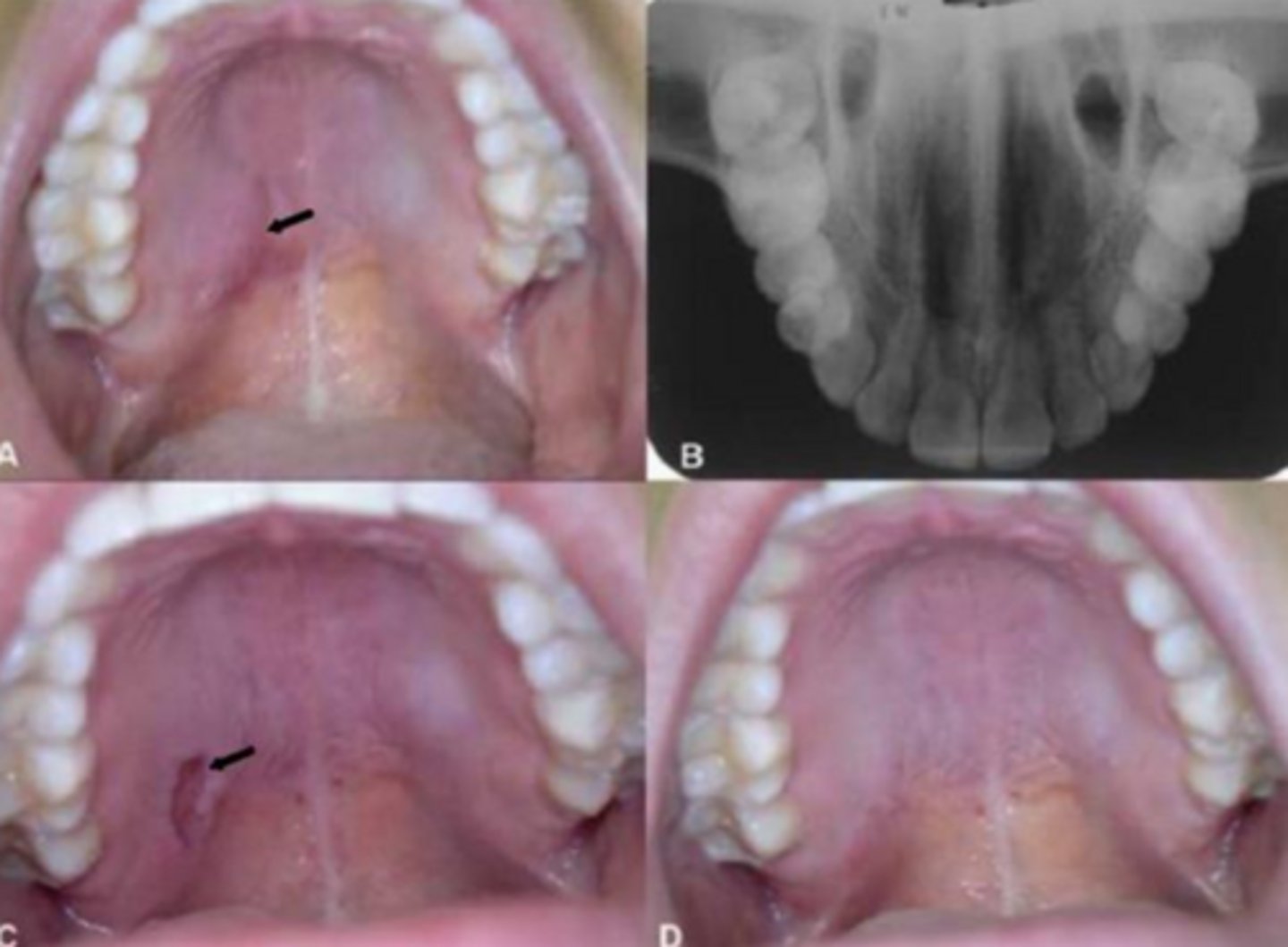 <p>necrotizing sialometaplasia</p>