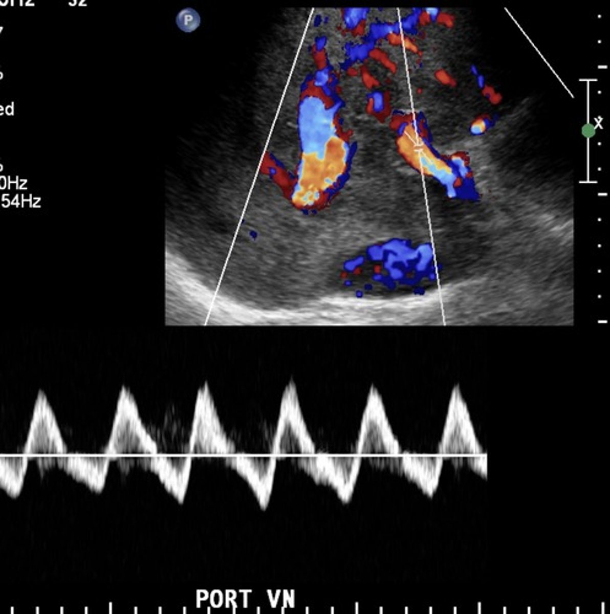 <p>Pulsatile</p><p>Biphasic</p>
