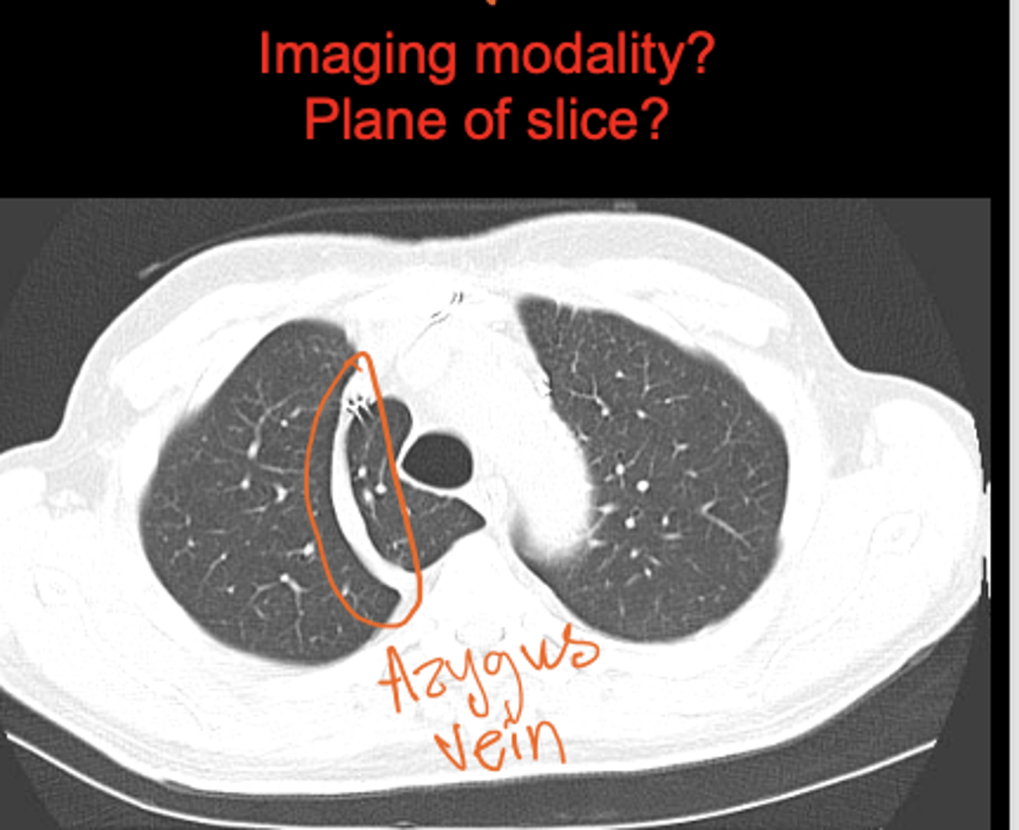 <p>A groove formed by the azygos vein at the right lung apex.</p><p>CT showing lung window</p>