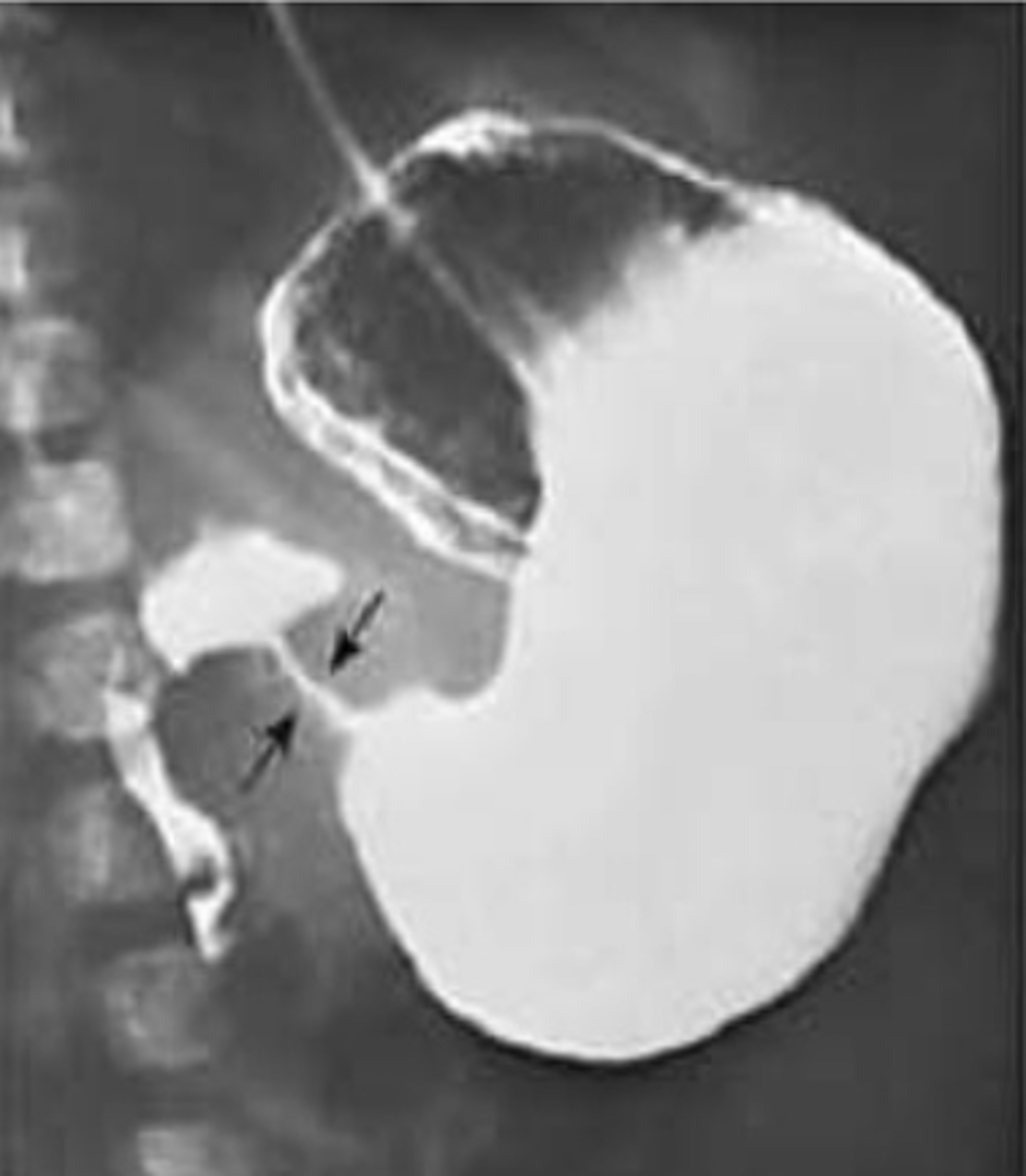 <p>Initial: abdominal US</p><p>Best: upper GI contrast series - string/apple core sign</p>