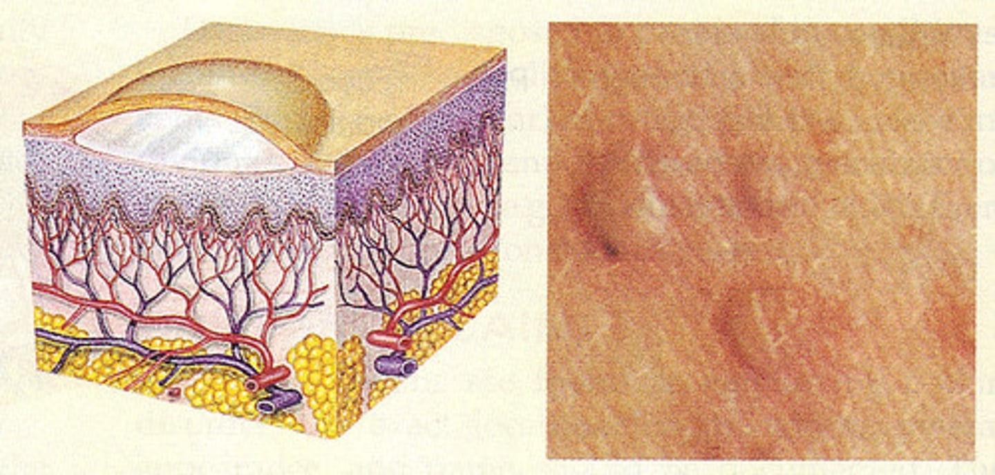 <p>primary lesion; small blister or sac containing clear fluid, lying within or just beneath the epidermis</p>