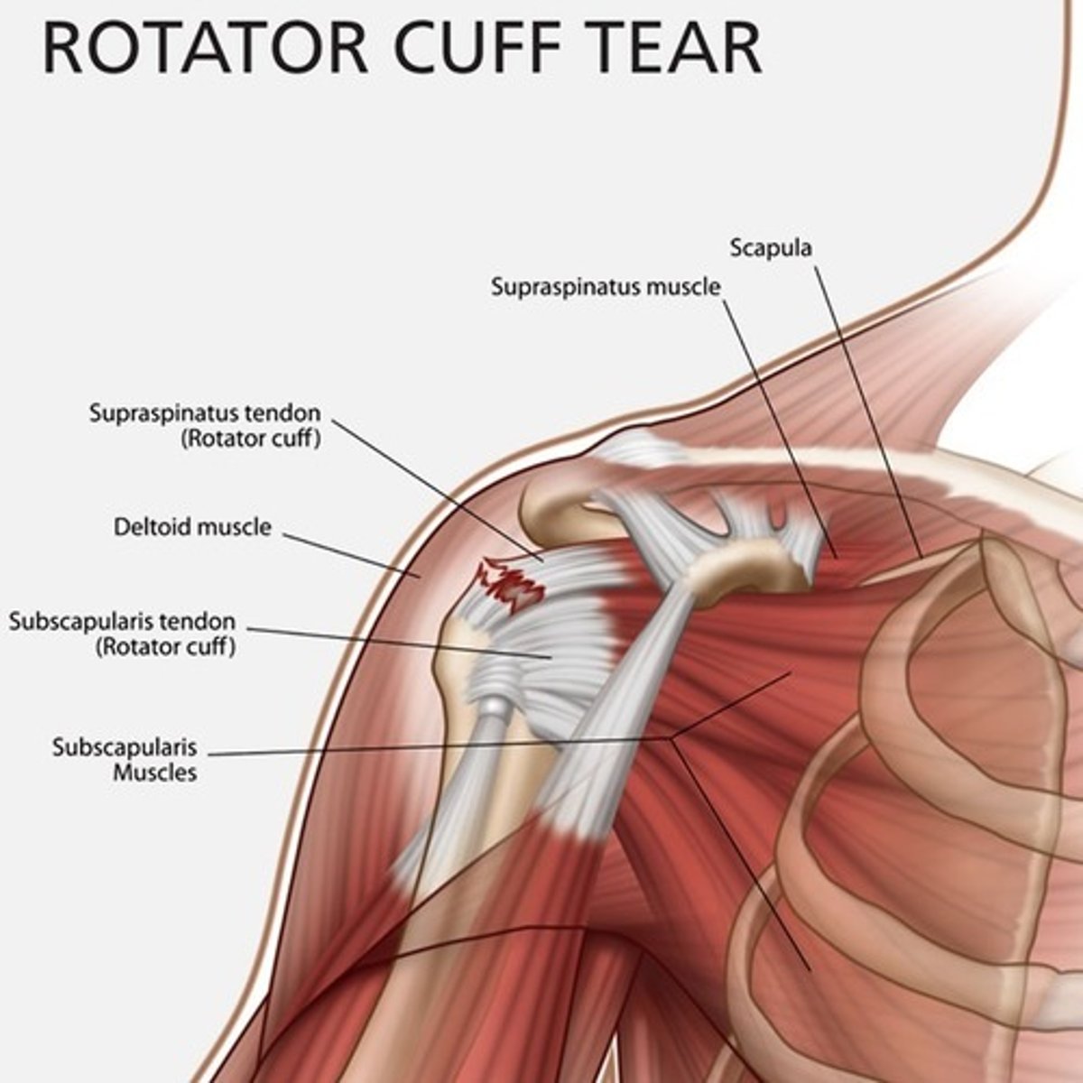 <p>secondary to trauma, degenerative changes, mechanical impingement and/or altered blood supply to tendons over time. Spontaneous, full-thickness rotator cuff tears occur typically in patients older than 50 and the supraspinatous tendon is most often affected. When a rotator cuff tear occurs in individuals under 40 years, it is usually because of aggressive physical injury and repeated trauma</p>