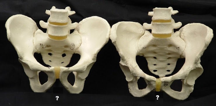 <p>Compare the pelvis on the left with the one on the right in the image below.  Is the pelvis on the right a male or female pelvis? \n A) female</p><p>B) male</p>