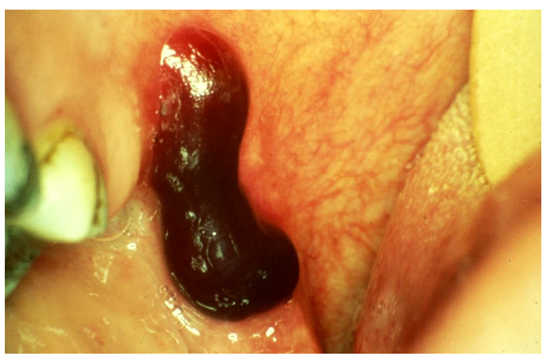 <ul><li><p>bulla </p></li><li><p><em>This patient has angina bullosa haemorrhagica</em></p></li></ul><p></p>