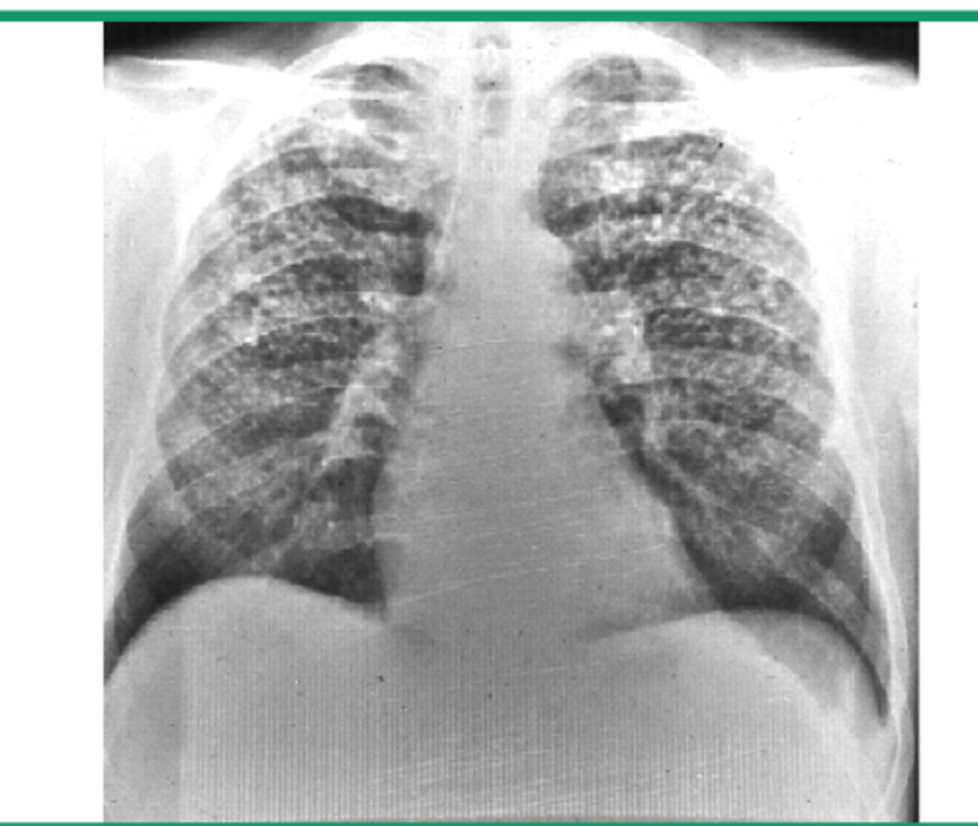 <p>silicosis</p>