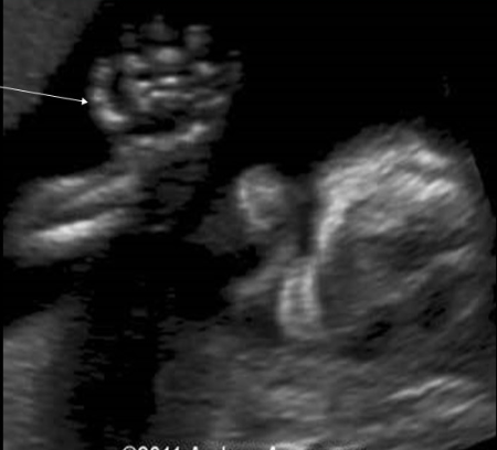 <p>which skeletal abn is defined by the arching/<strong>curving</strong> of <strong>4th/5th digits </strong>toward the thumb, along the axis of palm curvature</p><p>a) polydactyly</p><p>b) syndactyly</p><p>c) clinodactyly</p><p>d) rocker bottom foot</p>