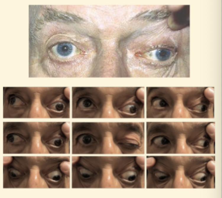 <ul><li><p>Ptosis</p></li></ul><p></p><ul><li><p> dilated pupil</p></li></ul><p></p><ul><li><p> eye positioned 'down and out'</p></li></ul><p></p><ul><li><p>Px likely to complain of diploma if acquired </p></li></ul><p></p>