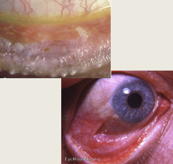 <ul><li><p>Symblepharon</p></li><li><p>Lid margin keratinization</p></li><li><p>meibomain gland disease/dry eye</p></li><li><p>corneal opacificaion&nbsp;</p></li><li><p>Distichiasis </p></li></ul><p></p>