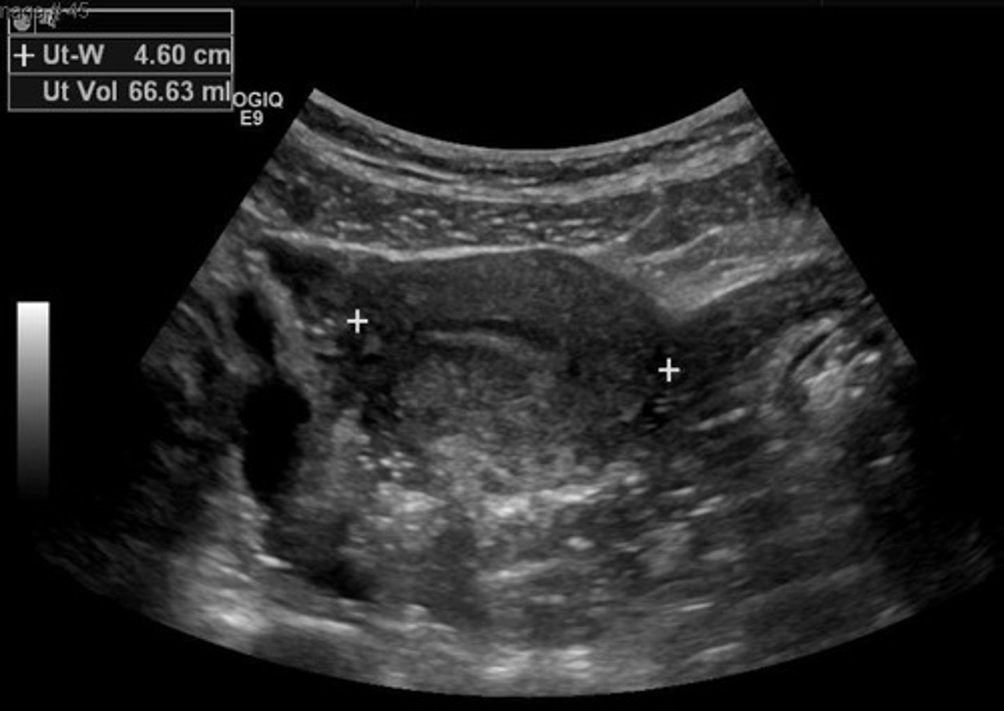 <p>Shows bladder, uterus body, endometrium, and ovaries.</p>