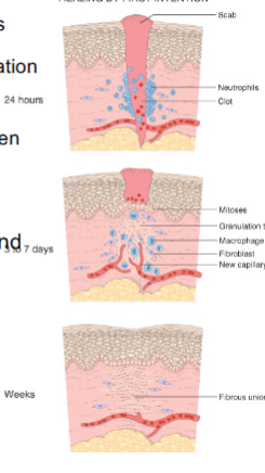 <p>connective tissue devoid of inflammation; epidermis intact</p>